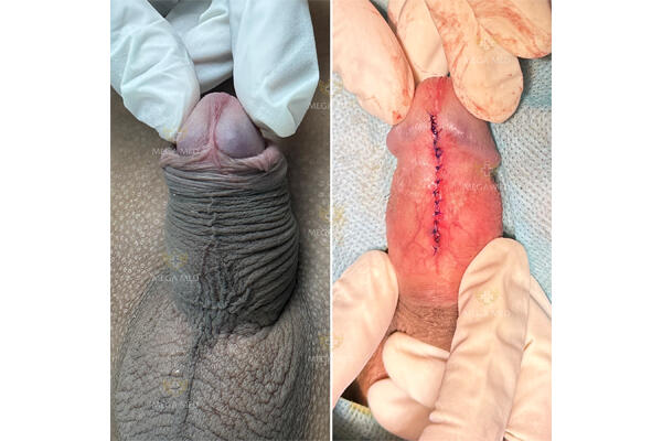 Hình ảnh chỉnh ngắn dây hãm